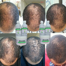 Rhabs Aloe Vera Hair Growth (Baldness Set)
