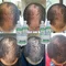 Rhabs aloe vera hair growth (baldness set)